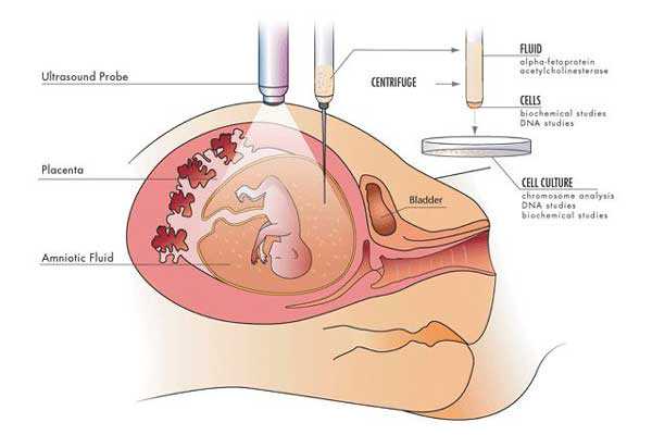 香港验血测男女需要多少钱,宫腔积液如何影响辅助生殖技术中助孕过程？